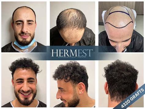 hermest clinic turkey|hermes hair transplant center turkey.